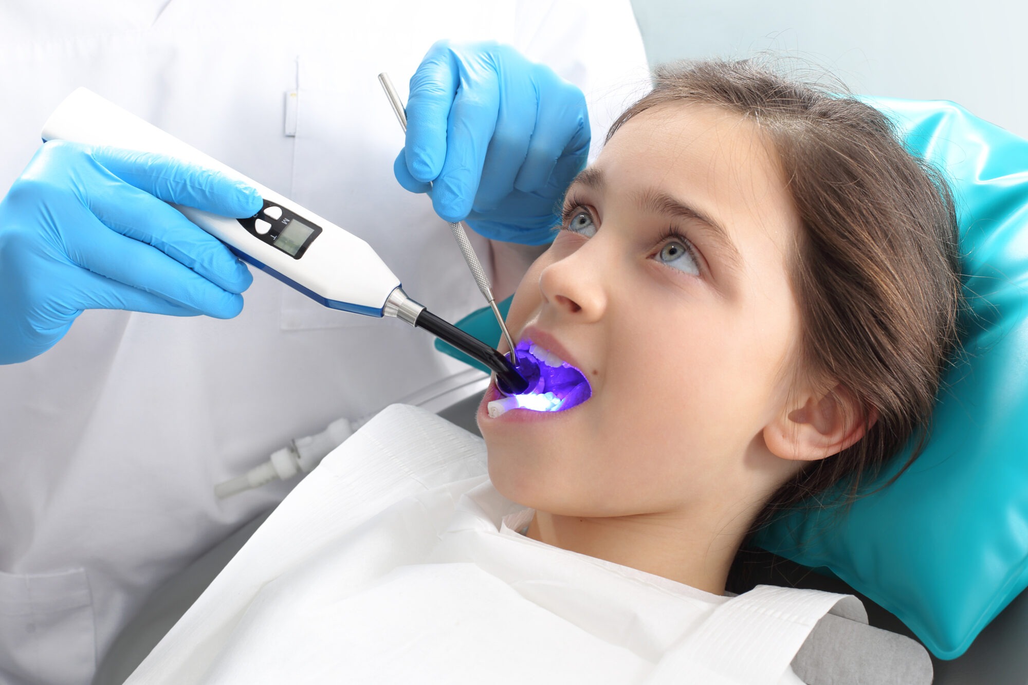 Dental Sealants for Cavity Prevention in Children and Teens
